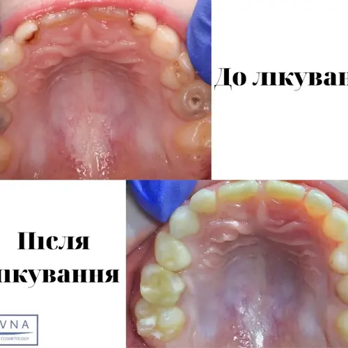 Лікування