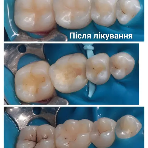 Лікування