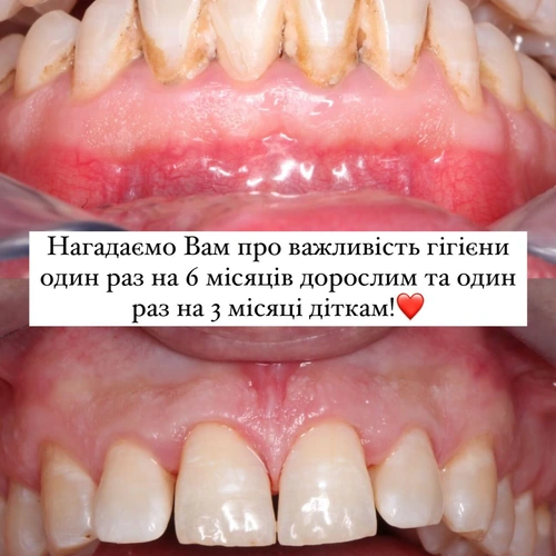 Професійна гігієна
