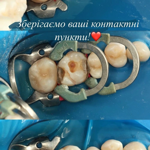 Лікування карієсу та художня реставрація зуба