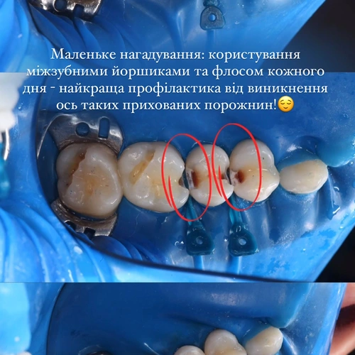 Лікування карієсу та відновлення зубів за методикою художньої реставрації