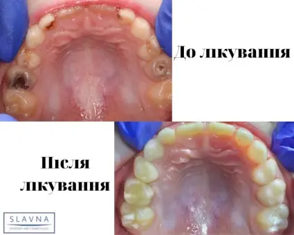 Лікування тимчасових зубів