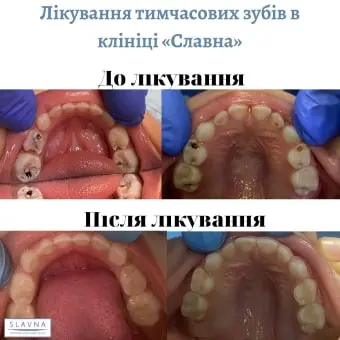 Лікування тимчасових зубів