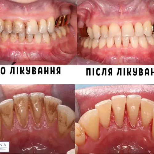 Лікування парадонтиту