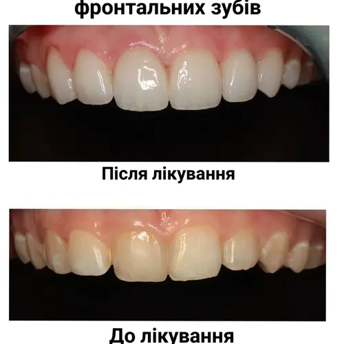 Лікування