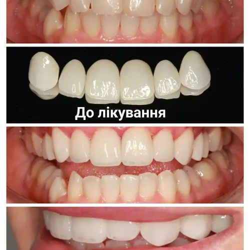 Лікування