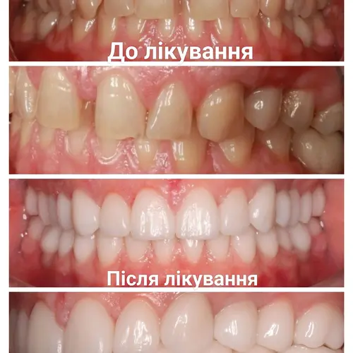 Лікування